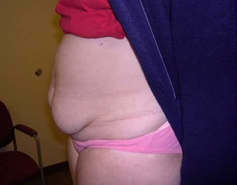 pierderea de grăsime tummy tuck 30 kg pierdere în greutate în 2 luni